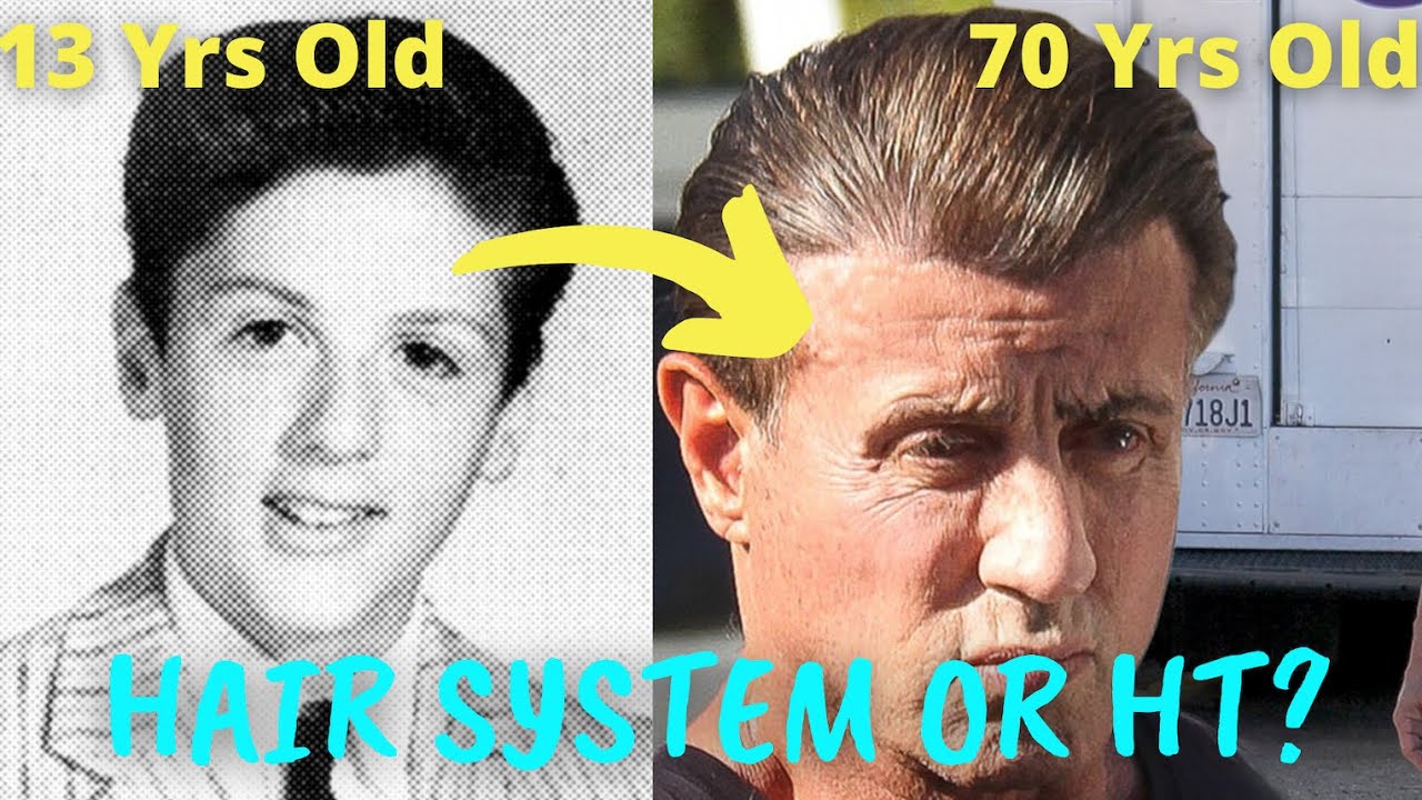 Sylvester Stallone Hair Transplant or Hair System? Dr. Nakatsui Responds