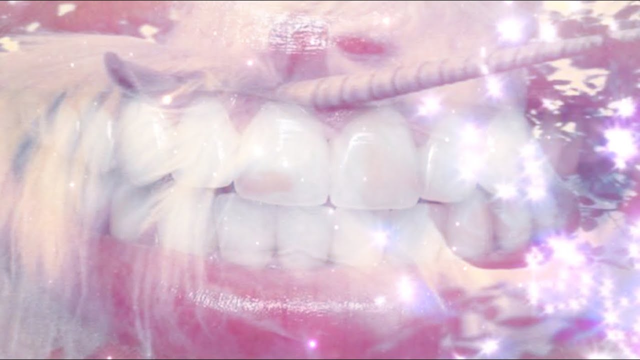 Palate.Expander [WIDER DENTAL ARCHES]