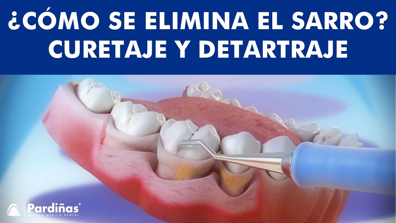 ¿Cómo se ELIMINA EL SARRO? - Curetaje y limpieza dental ©