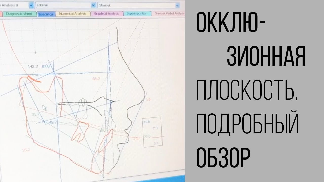Окклюзионная плоскость. Комментарии нашего ортодонта с рисунками. Поймет даже ребёнок.