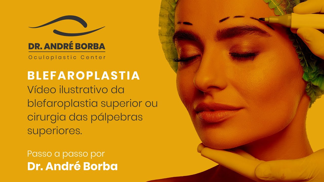 Blefaroplastia ou cirurgia das pálpebras superiores - Passo a passo por Dr. André Borba