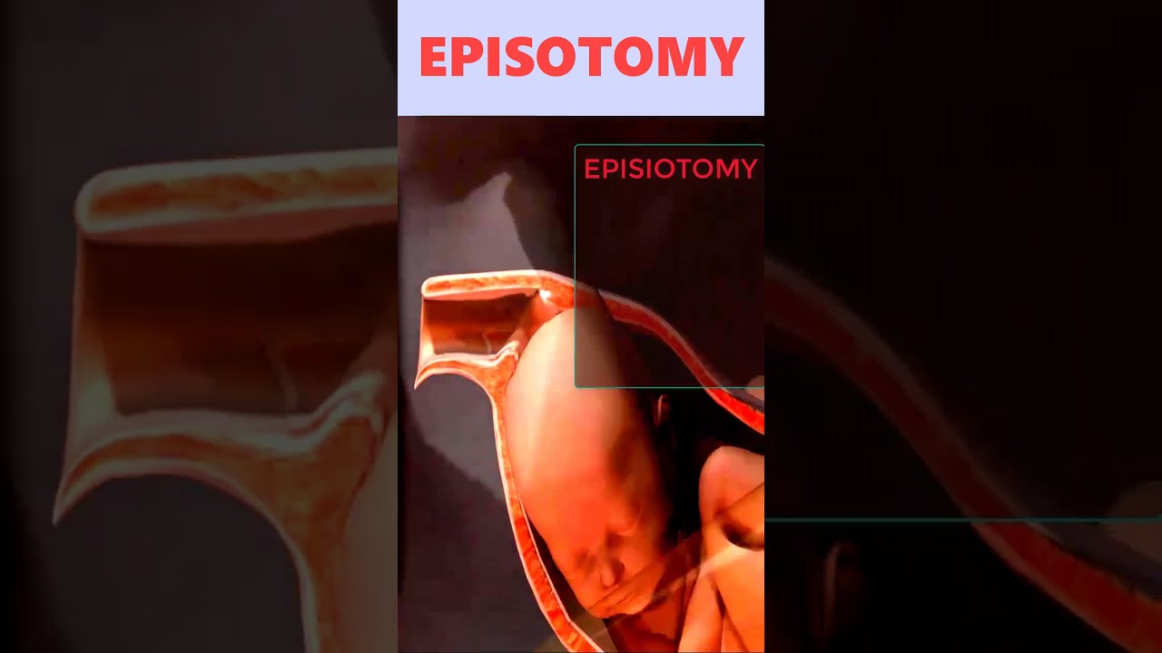 Хирургический разрез при эпизиотомии 🙅👙 #шорты #роды