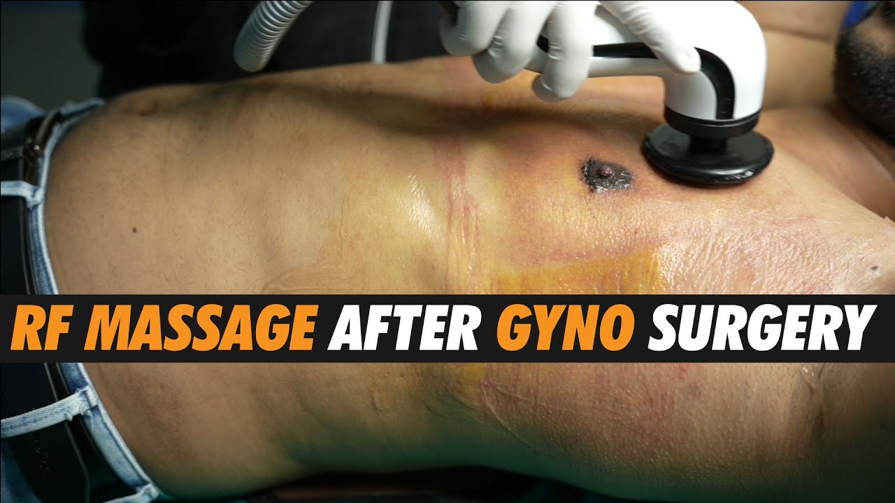 Gynecomastia Surgery result. RF massage & Dressing removal