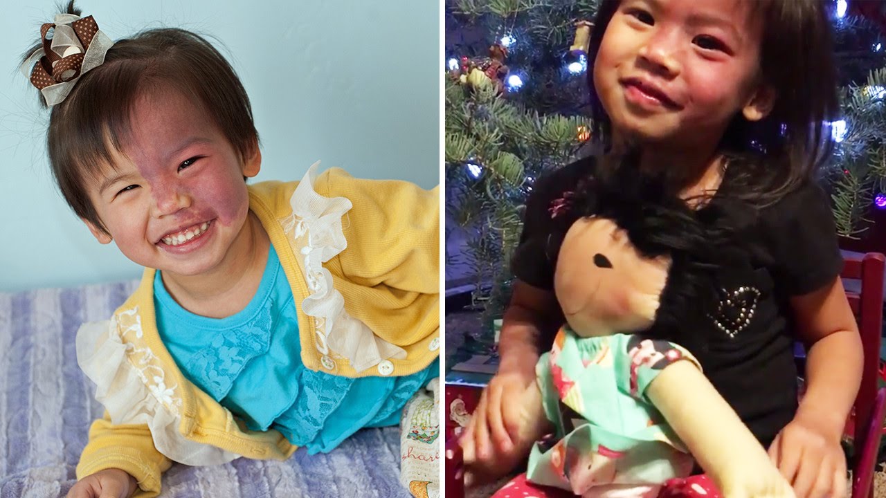 Girl With Rare Birthmark On Face Gets Special Doll That Looks Just Like Her