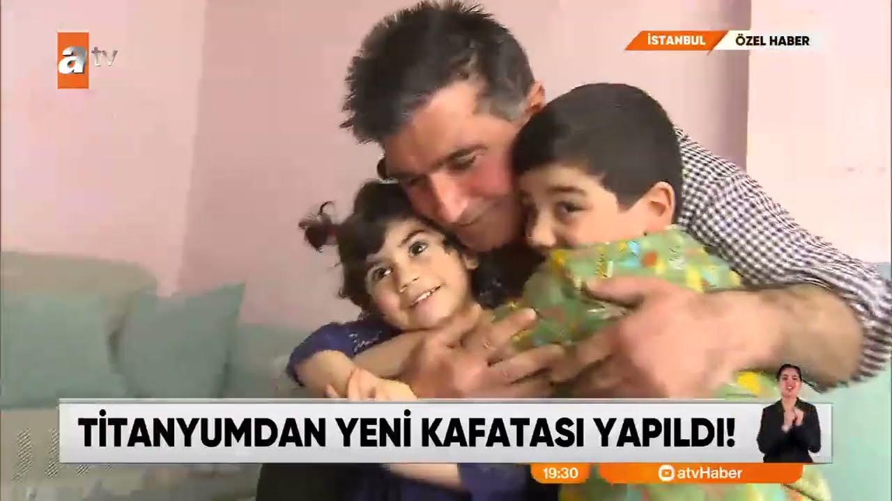 Titanyumdan Kafatası Yapıldı.