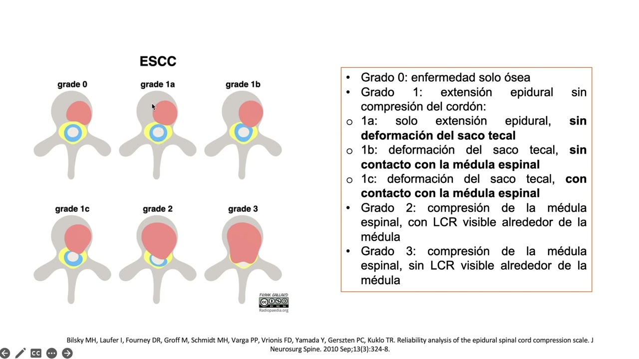 Manejo del S&iacute;ndrome de Compresi&oacute;n Medular por Mieloma M&uacute;ltiple: radioterapia o cirug&iacute;a?