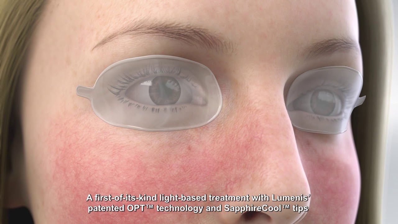 Intense Pulsed Light (IPL) | Ocular Rosacea | Dry Eye | VisionOptique