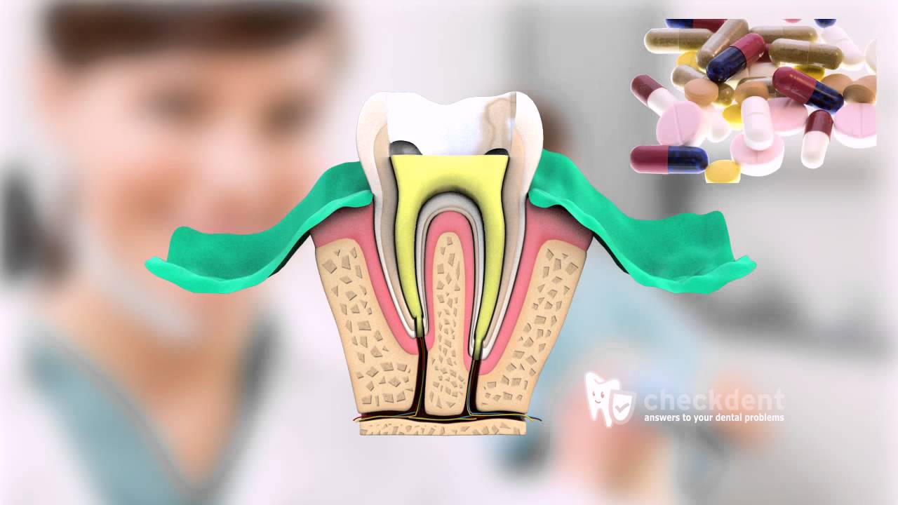 What is a Root Canal Treatment