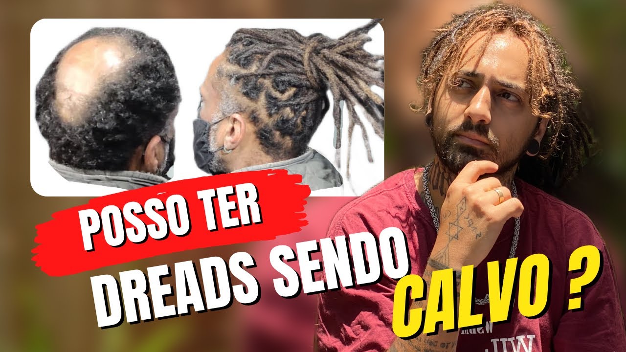 Posso ter dreads sendo calvo ? - Dread e calvície