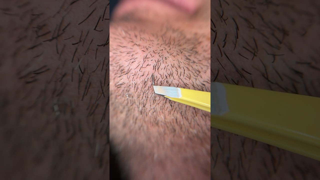 Plucking my bf&rsquo;s thick beard hairs #beardplucking #thickhair #hairfollicle #extraction #skincare