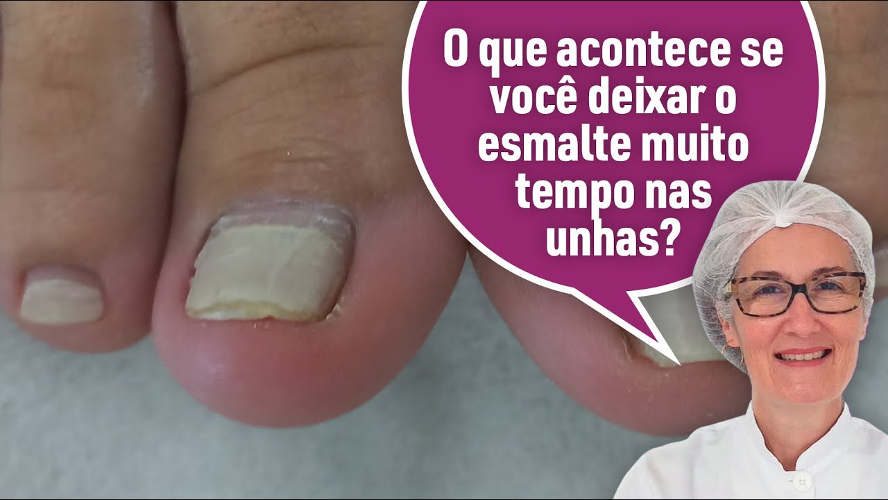 O QUE ACONTECE SE DEIXAR O ESMALTE MUITO TEMPO NAS UNHAS?