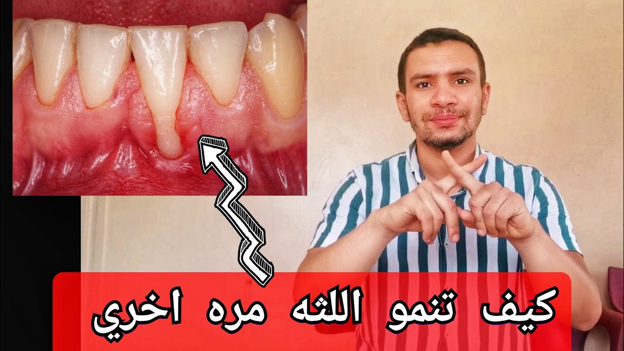 هل هناك طريقة لعكس تراجع اللثه و كيف؟
