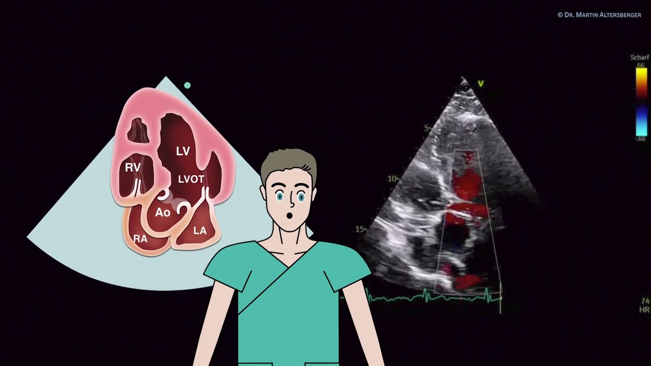 〖Echocardiography〗 Apical views - the 5-ChV, AR, use of CW❣️