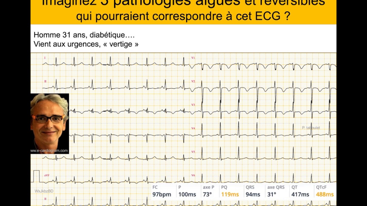 ECG avec ondes T inversées V1V2V3. Cas clinique homme 31 ans. Quiz Dr Taboulet