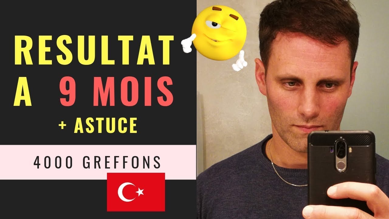 Greffe de cheveux FUE en Turquie [Vidéo 20] - Résultat à 9 mois + Astuce - 4000 Greffons