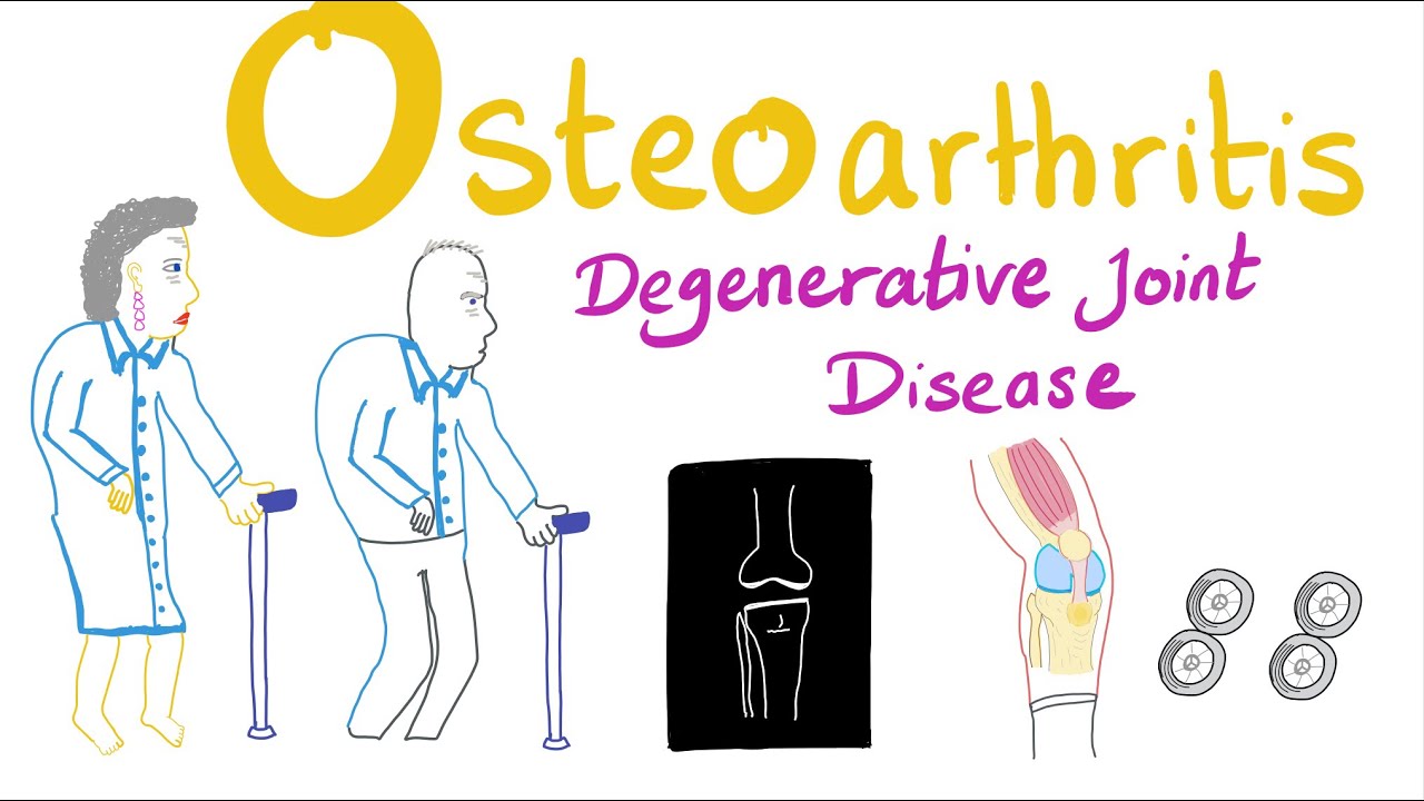 Osteoarthritis (OA) - Introduction - Rheumatology Series