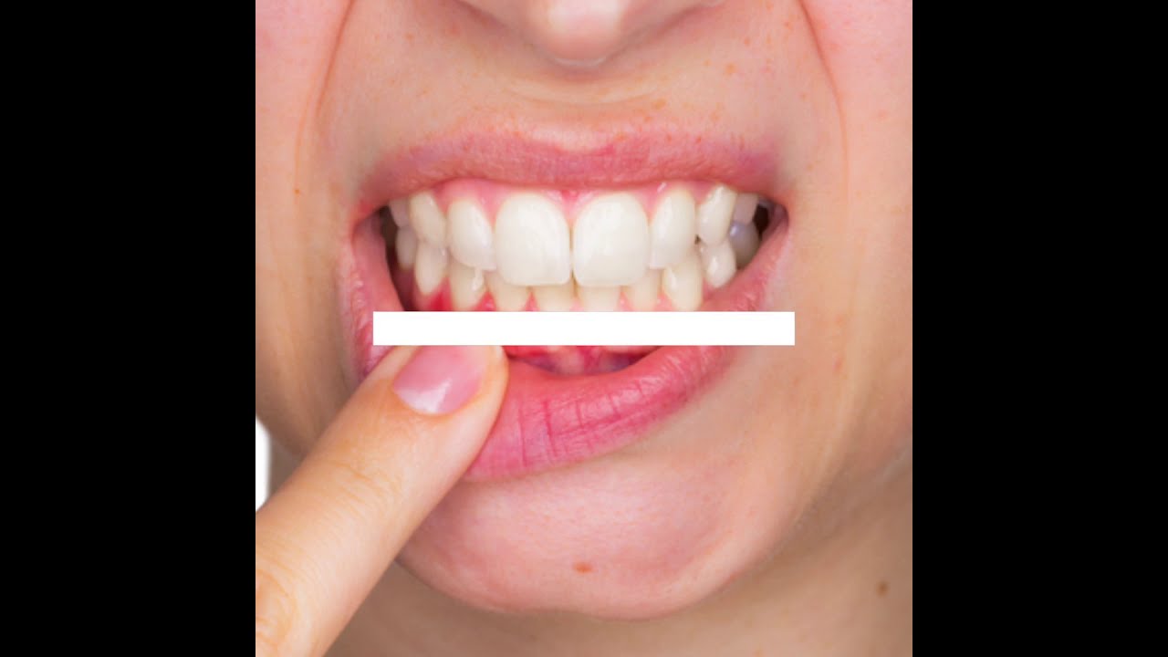 Pinhole Surgical Technique at Paradise Dental Associates LLC in Salem, MA