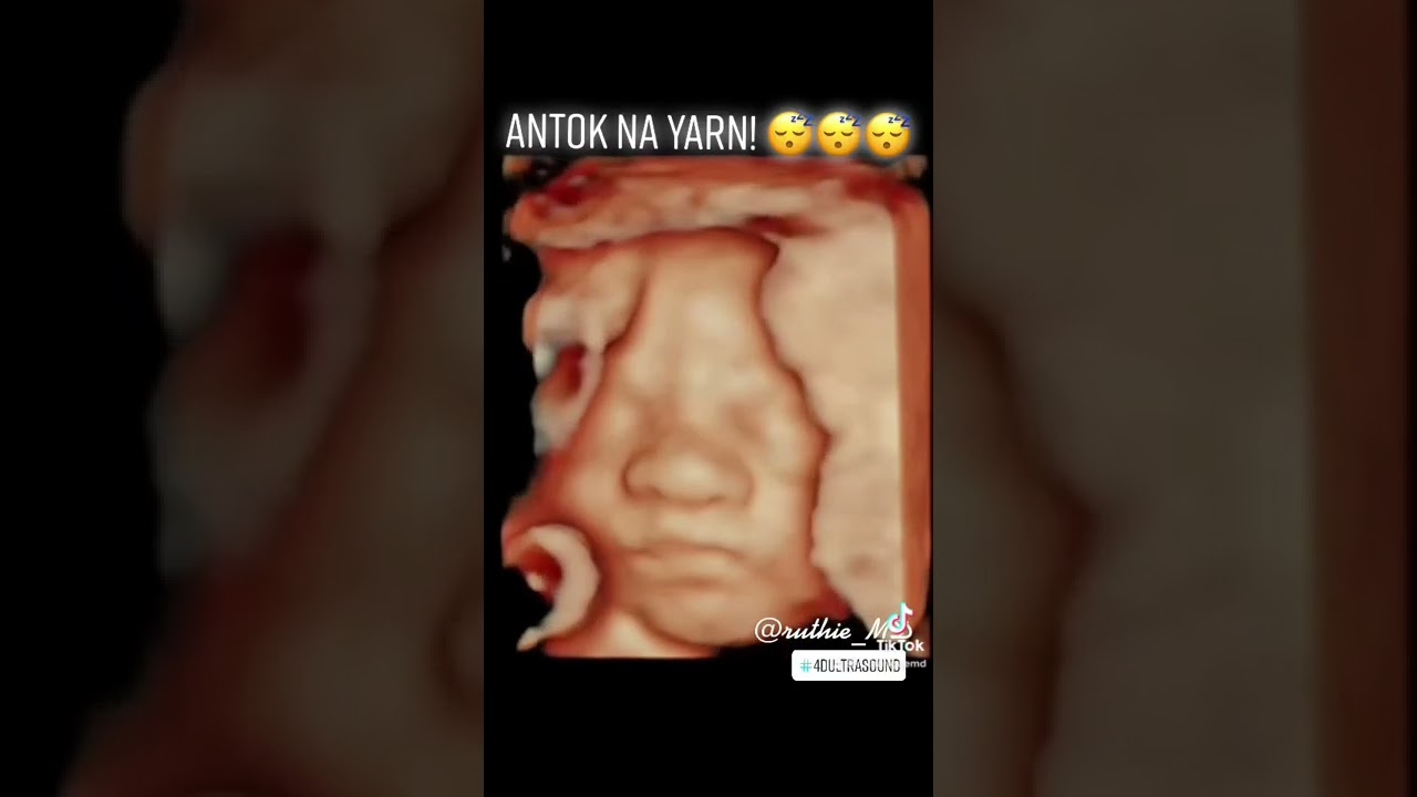 4D HD Live Ultrasound  at Heart of Wellness Ultrasound Center, Robinson’s Place Malolos❤️
