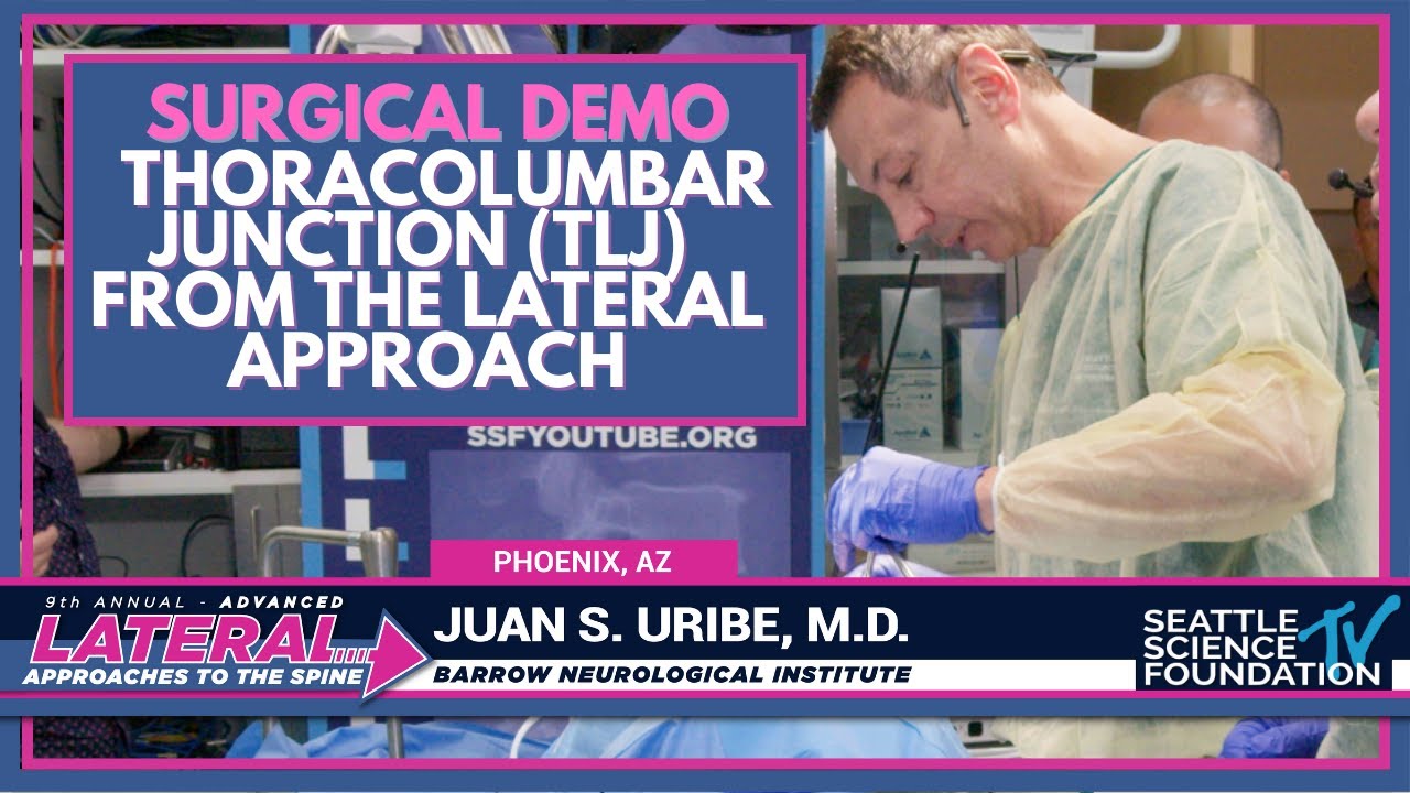 Грудопоясничное соединение (ГПС) при боковом доступе - Хуан С. Урибе, доктор медицинских наук.