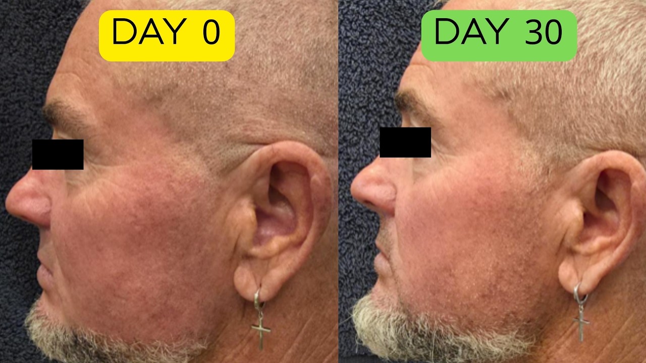 This Green Tea + Red Light Therapy Combo Changed His Skin in 30 Days (Photos)