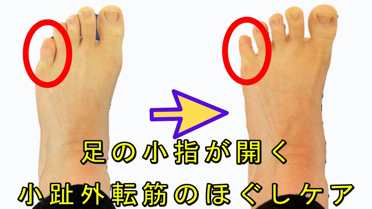 ②【足の小指を開く】薬指とくっついて離れない足の小指を開く小趾外転筋セルフケア