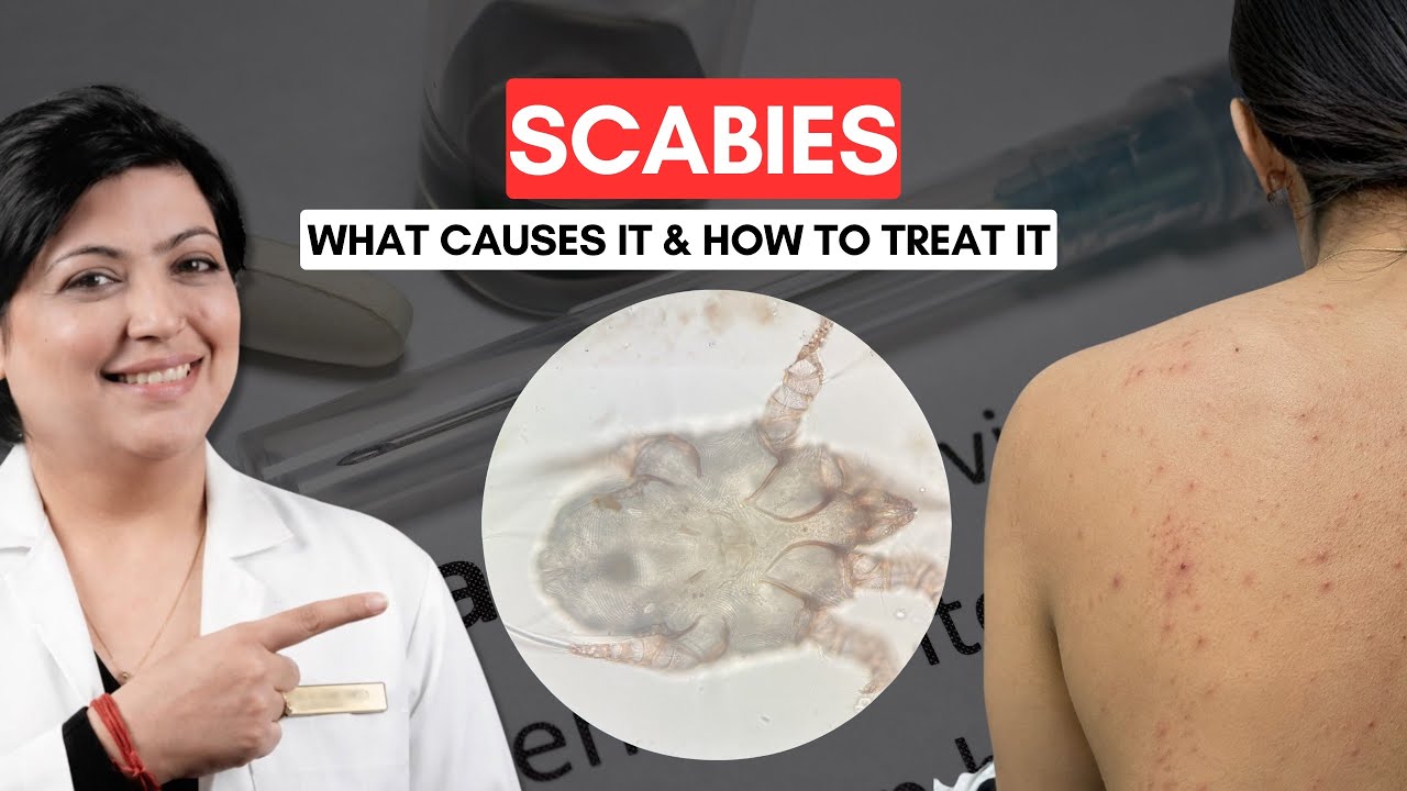 Scabies FAQs Answered | Dr Nivedita Dadu Explains Treatment, Pregnancy, Babies & Recurrence