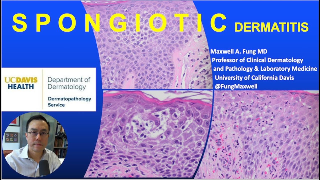 DERMATOPATHOLOGY: Spongiotic Dermatitis