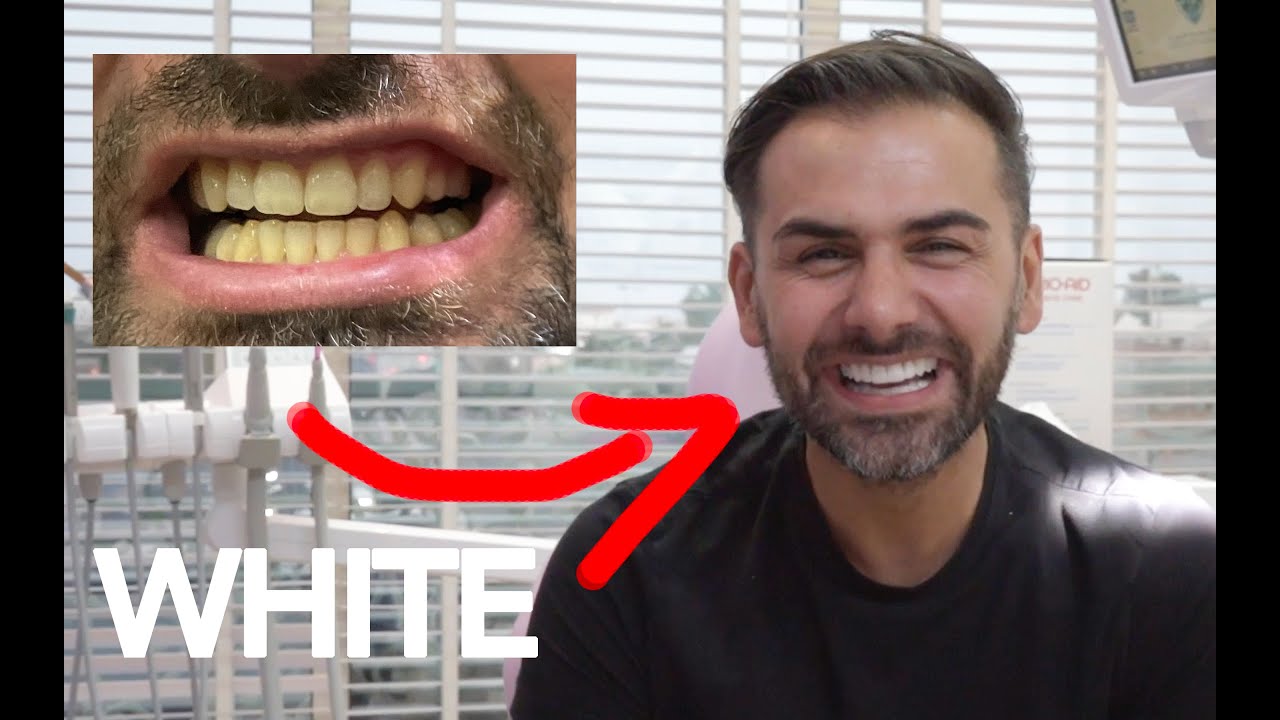 WHITE TEETH without damaging yours. In 1 day.