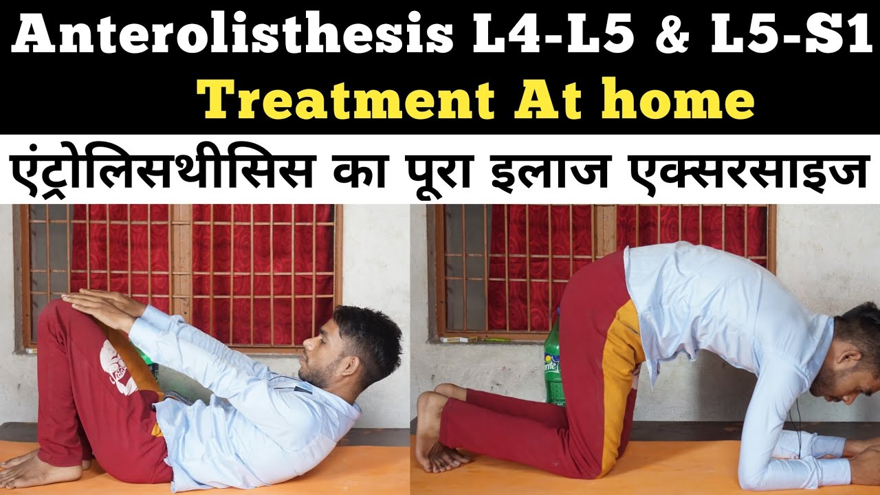 anterolisthesis l5 s1 treatment, anterolisthesis l5 s1 exercises, anterolisthesis grade1,l4 over l5