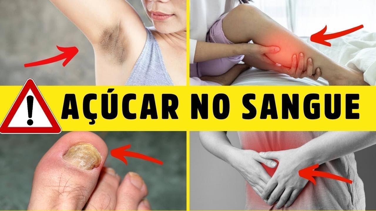 10 SINAIS PERIGOSOS de que seu AÇÚCAR está ALTO no SANGUE - Dr. Alain Dutra