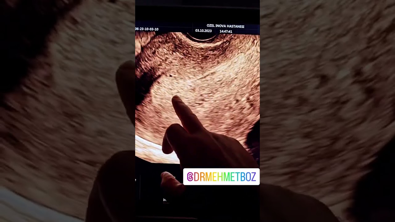 RAHIM ICINDE KALINLASMA. ENDOMETRIAL HIPERPLAZI. TANI VE TEDAVI AMACLI KURETAJ