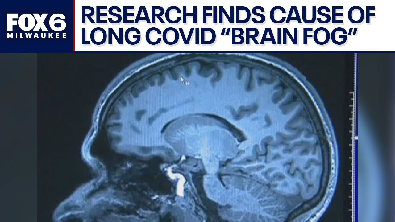 Long COVID 'brain fog,' doctor discusses research that identified cause | FOX6 News Milwaukee