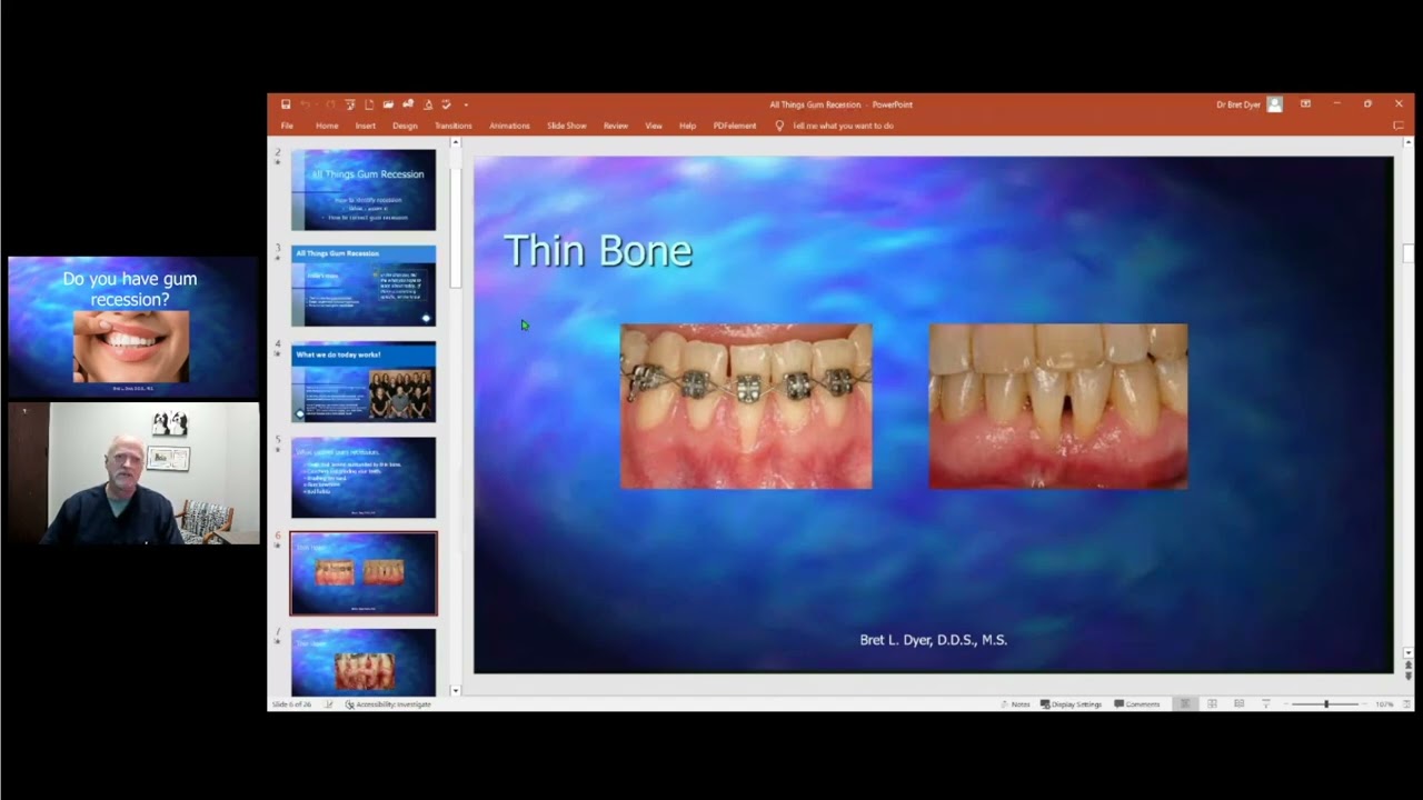 Receding Gums: A Complete Guide on Causes and Solutions