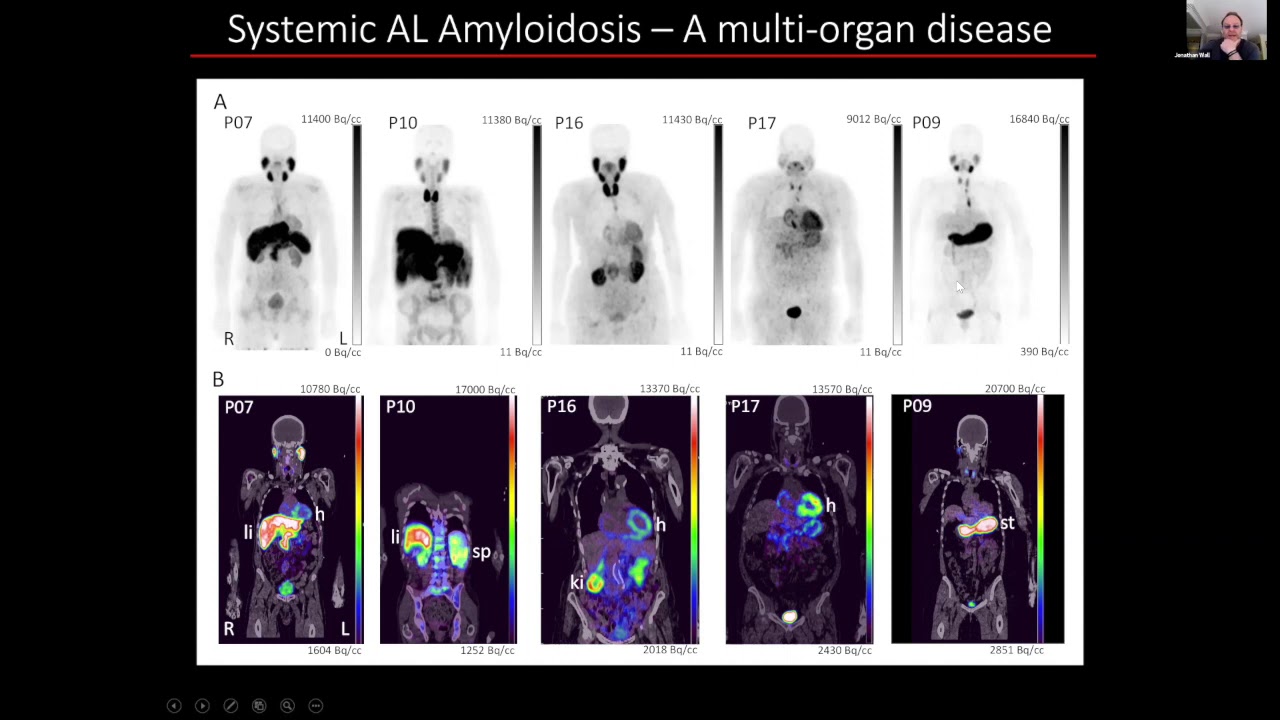 Imaging AL Light Chain Amyloidosis: 02/20/2021 Update