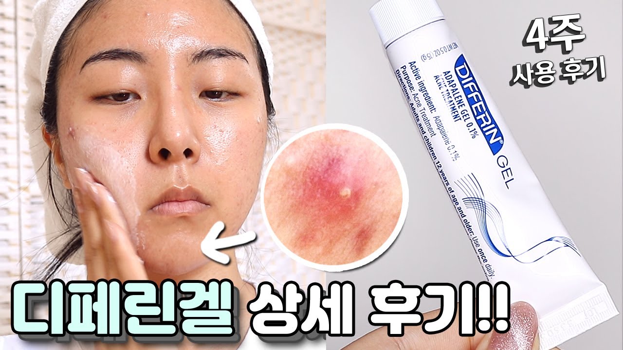 디페린겔 여드름에 진짜 효과 있을까!?