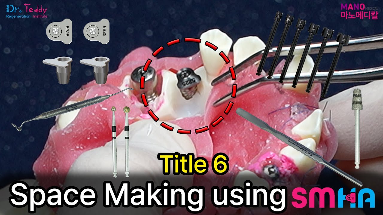 Title 6 Space Making using SMHA #dr_teddy_regeneration_institute #manomedical #dentalclinic