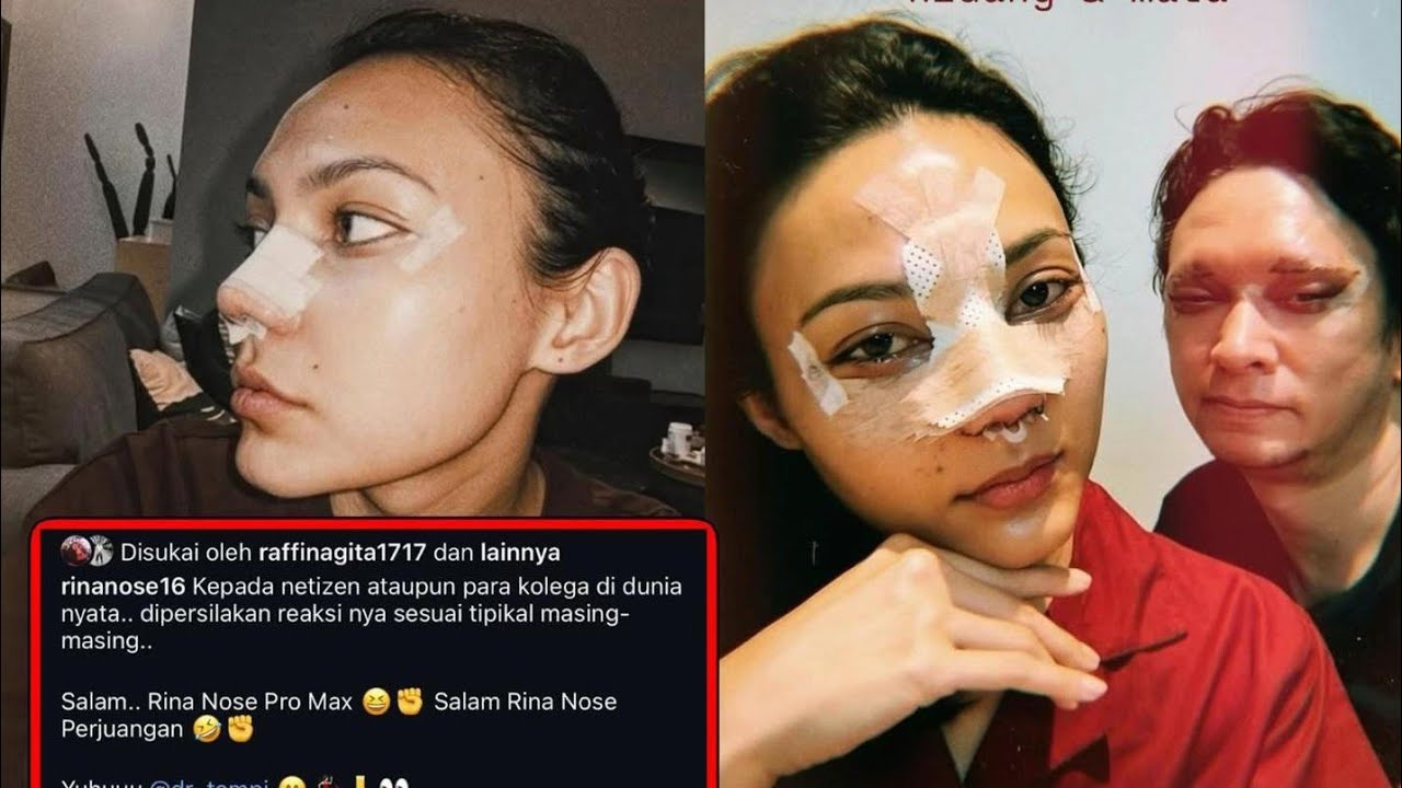 Rina Nose Oprasi Hidung Ciri khasnya Hilang ??!!