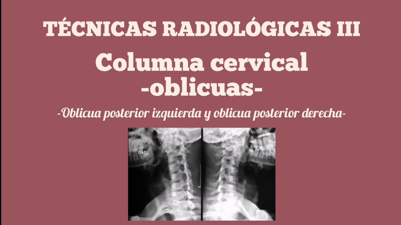 Proyecciones oblicuas de columna cervical | Oblicua Posterior Izquierda y Oblicua Posterior Derecha