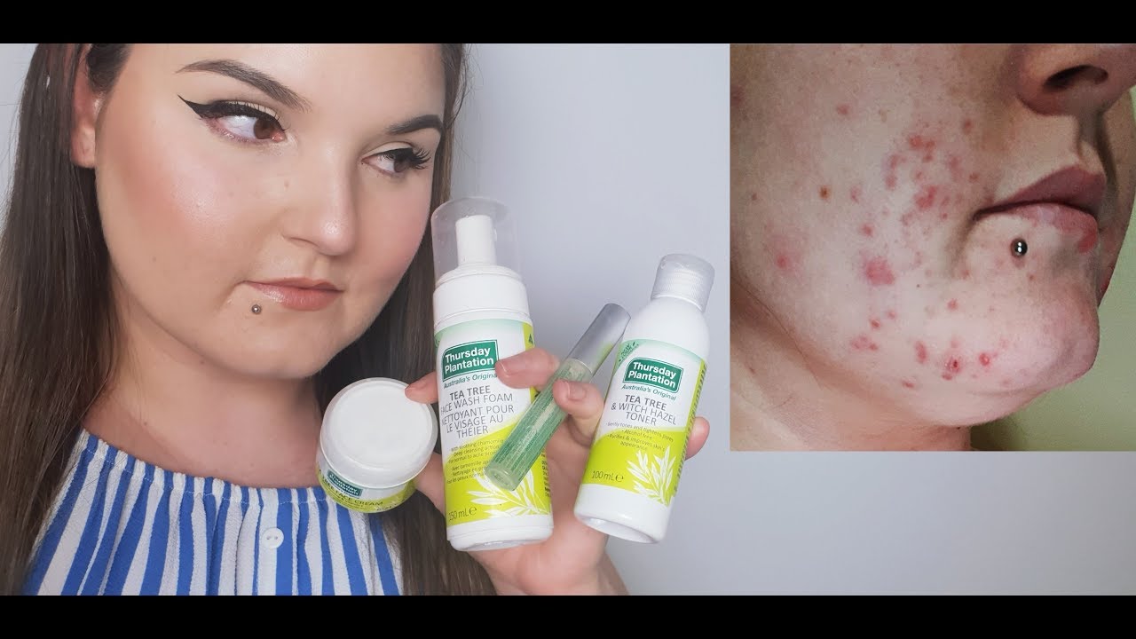 GETTING RID OF MY ACNE + HUGE GIVEAWAY