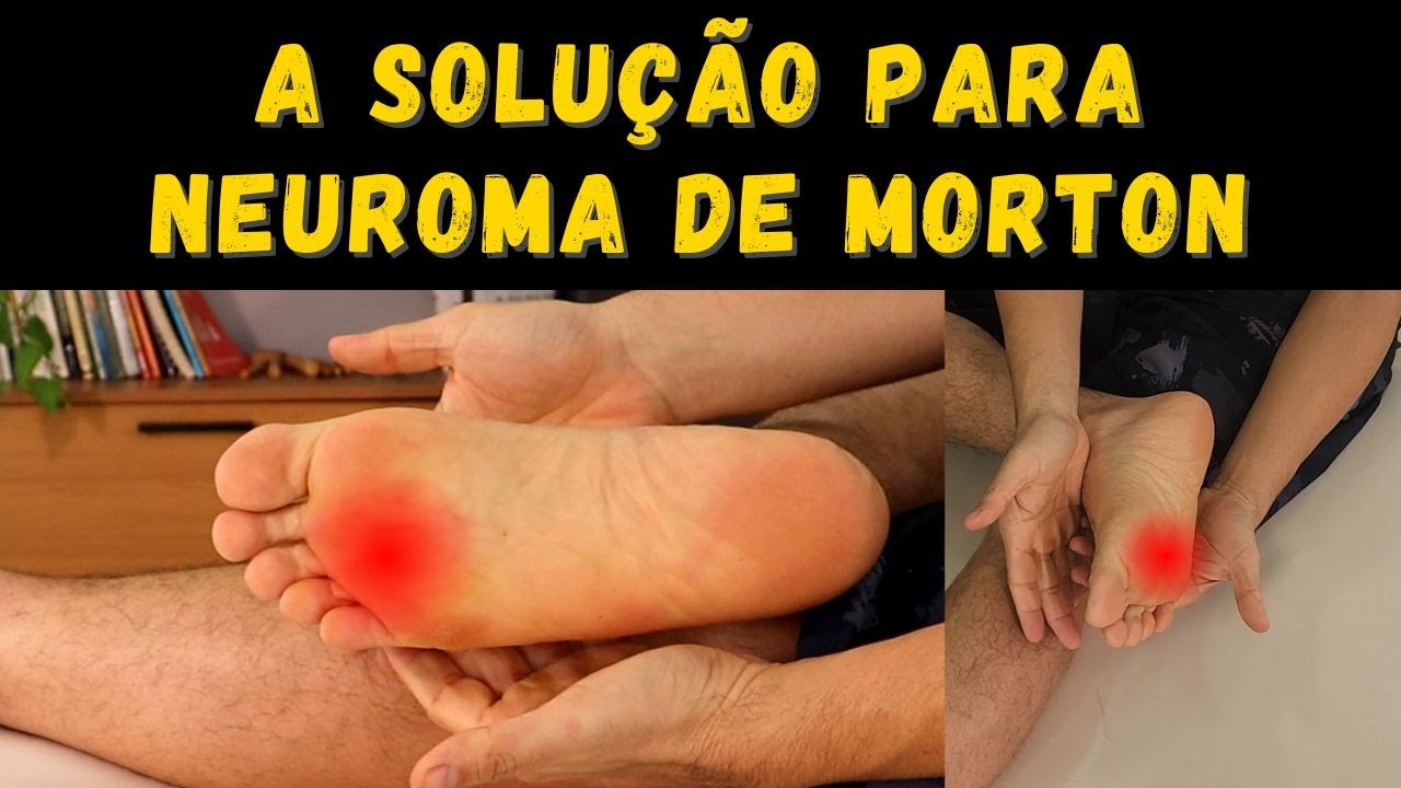 Tratamento para Neuroma de Morton