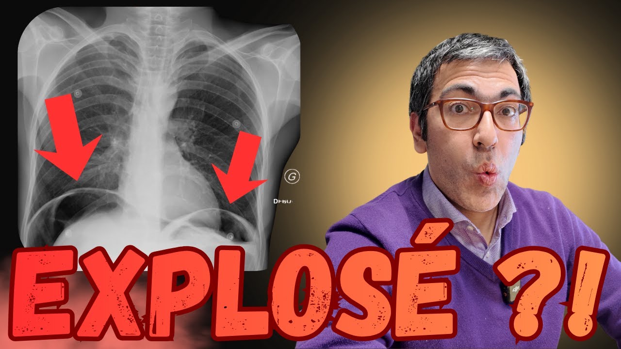 Schizophrène : On ne le croyait pas... Son estomac a PERFORÉ