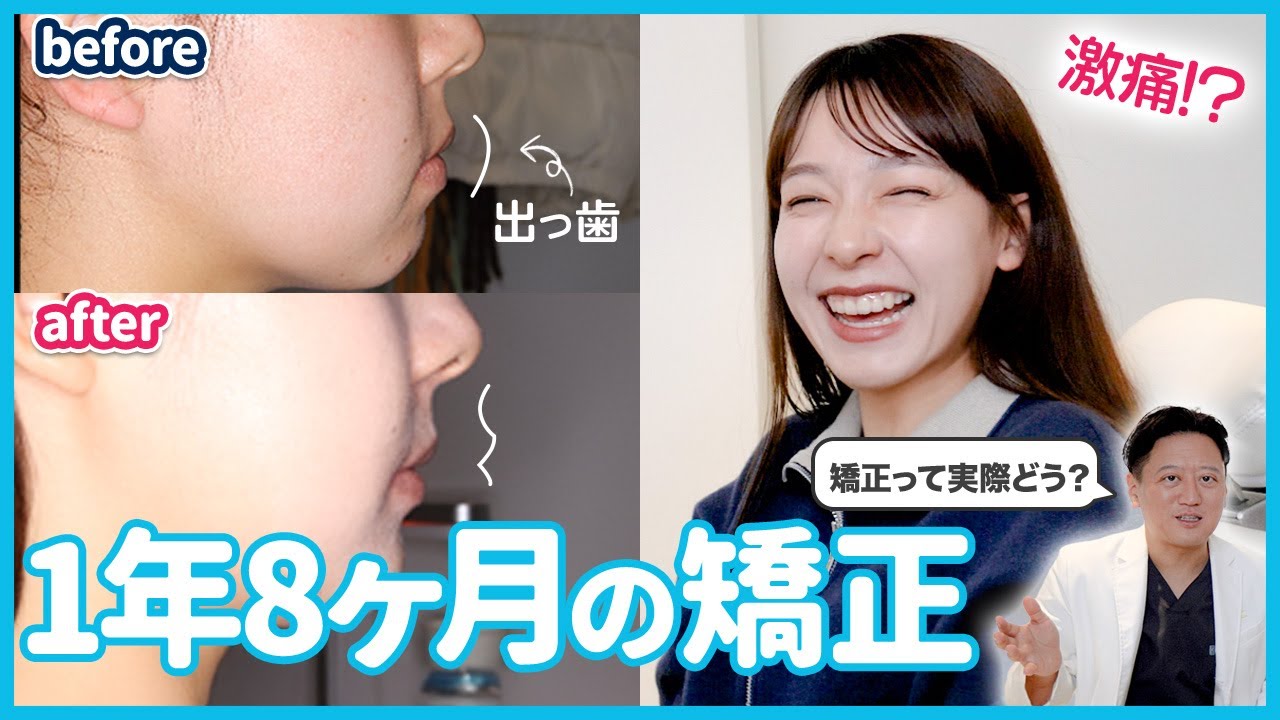 26歳保育士の矯正治療！口ゴボの改善でフェイスラインが整って綺麗なEラインに！【審美歯科 歯列矯正 歯並び 対談】
