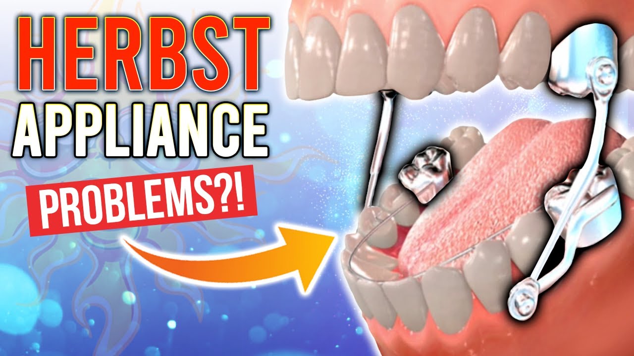 Herbst Appliance Problems With BRACES?!
