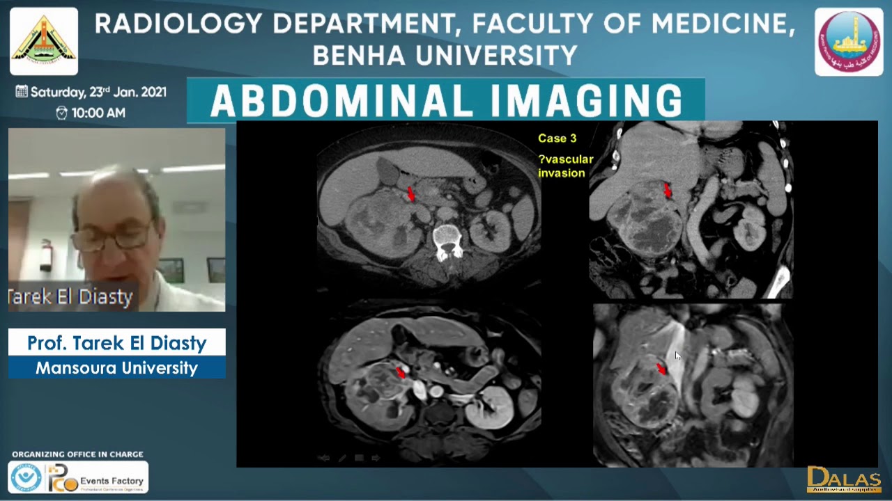 Renal Cell Carcinoma and mimics: case presentation