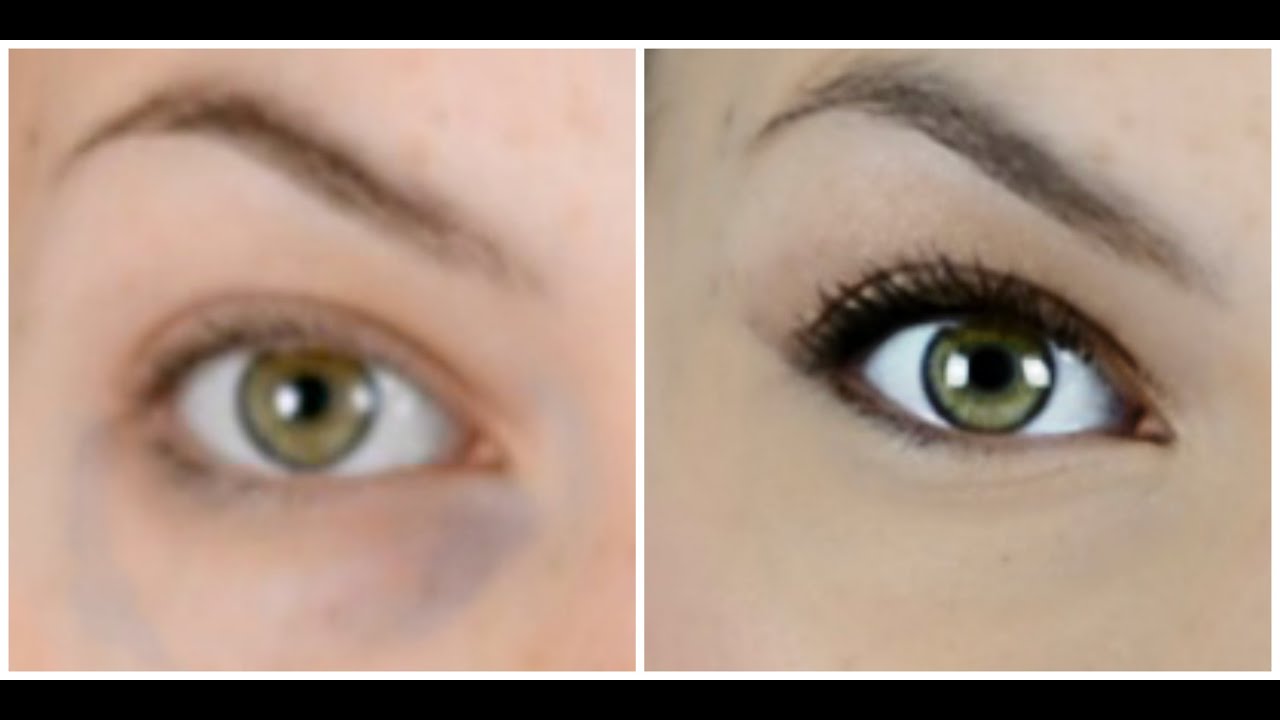 COMO ELIMINAR LAS BOLSAS DE LOS OJOS