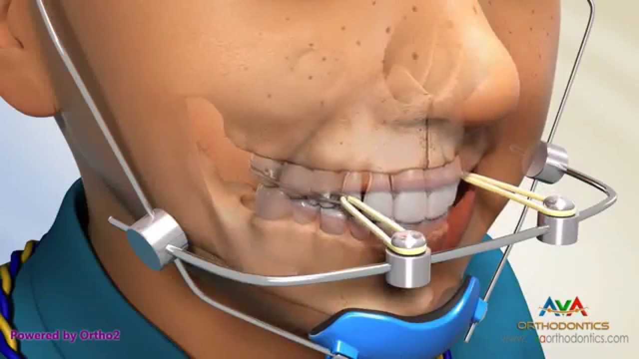 Orthodontic Treatment for Underbite or Crossbite - Facemask or Reverse Pull Headgear