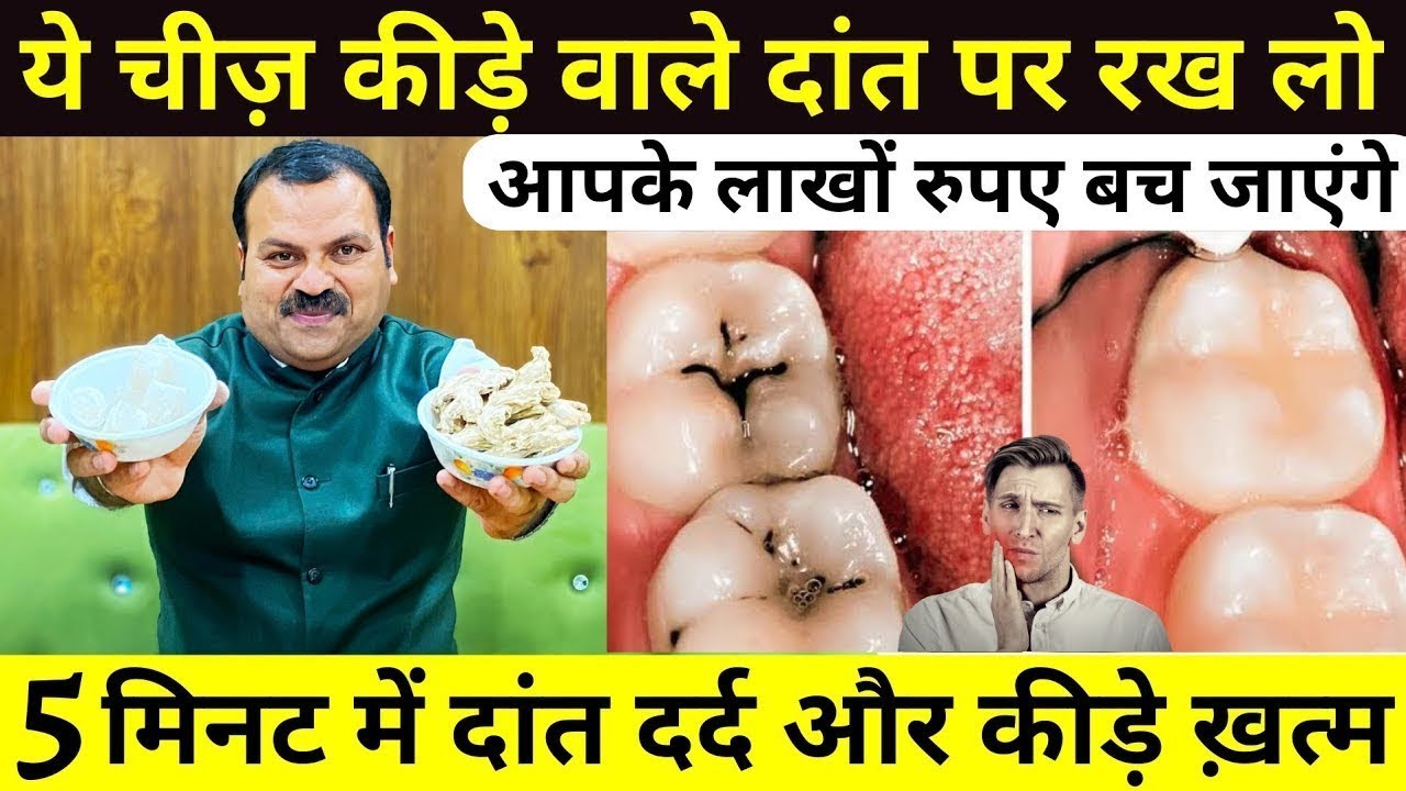 एक बार में दांत का कीड़ा और दर्द बाहर निकालने का बेहतरीन उपाय - How To Get Rid Of Tooth Cavity
