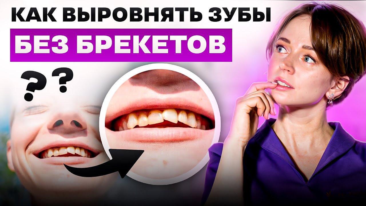 КАК ИСПРАВИТЬ КРИВЫЕ ЗУБЫ БЕЗ БРЕКЕТОВ?