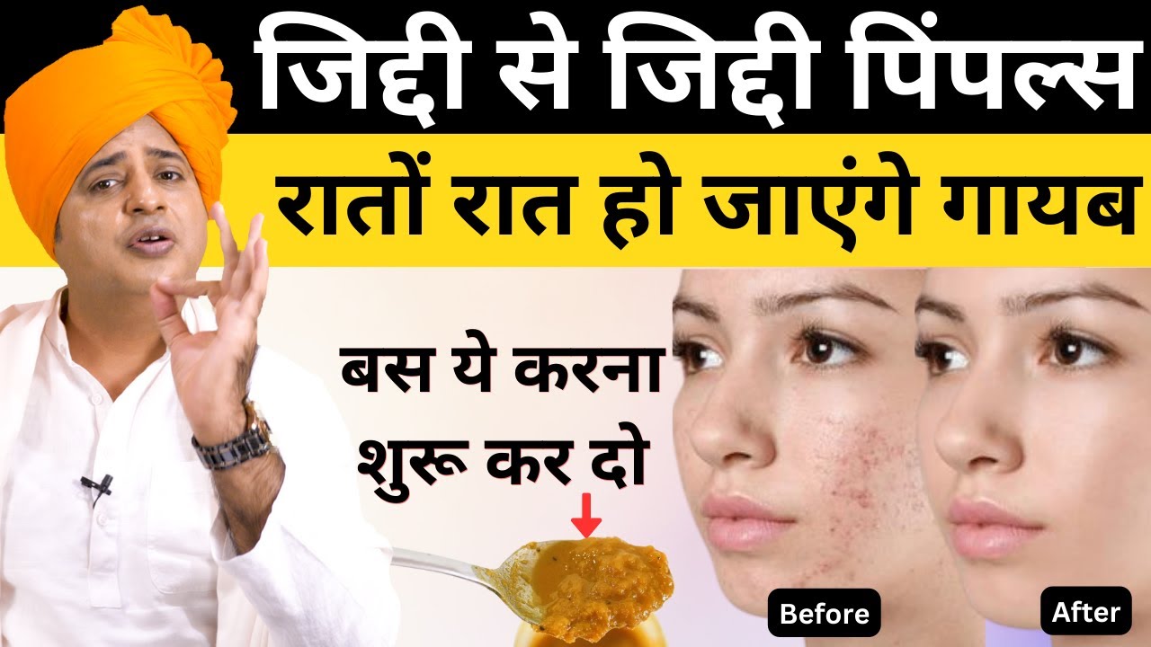 जिद्दी से जिद्दी पिंपल्स रातों रात हो जाएंगे गायब, बस ये करना शुरू कर दो || Sanyasi Ayurveda ||