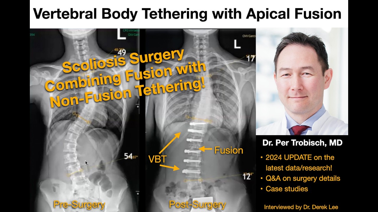 Dr. Per Trobisch, MD on Vertebral Body Tethering (VBT) with Apical Fusion.  Latest Update!
